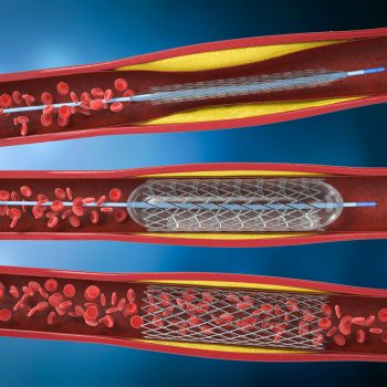 Angioplasti Koroner: Mengenal Lebih Jauh Prosedur Pemasangan Ring Jantung