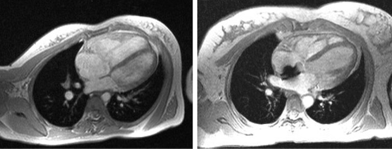 Atrial Septal Defect (ASD): Gejala, Penyebab, Pengobatan, dan Pencegahannya
