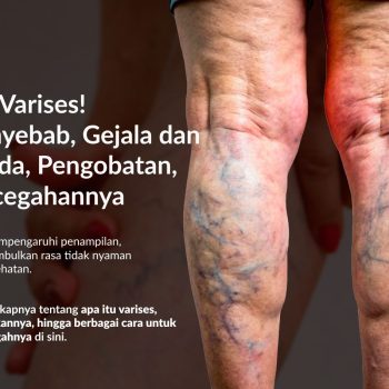 Waspadai Varises! Kenali Penyebab, Tanda-Tanda, Pengobatan, dan Pencegahannya