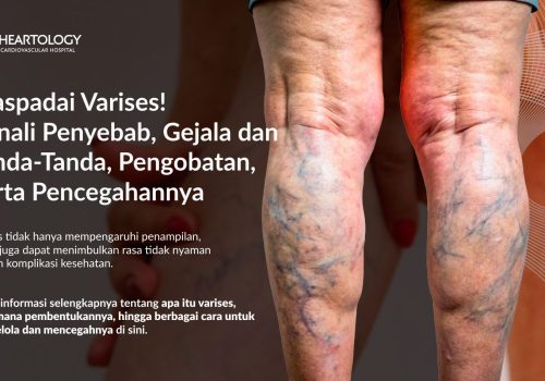 Waspadai Varises! Kenali Penyebab, Tanda-Tanda, Pengobatan, dan Pencegahannya