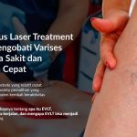 Endovenous Laser Treatment (EVLT) Mengobati Varises Tanpa Rasa Sakit dan Pemulihan Cepat
