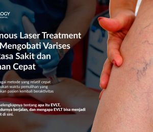 Endovenous Laser Treatment (EVLT) Mengobati Varises Tanpa Rasa Sakit dan Pemulihan Cepat