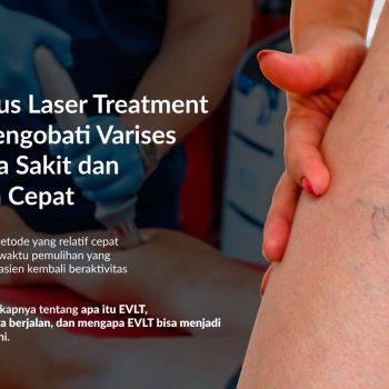 Endovenous Laser Treatment (EVLT) Mengobati Varises Tanpa Rasa Sakit dan Pemulihan Cepat