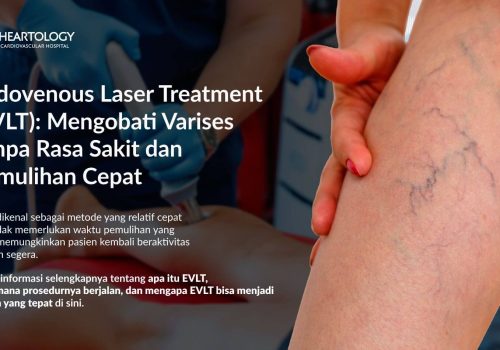 Endovenous Laser Treatment (EVLT) Mengobati Varises Tanpa Rasa Sakit dan Pemulihan Cepat