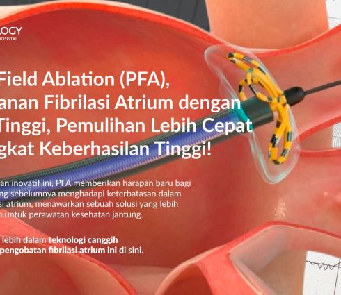 Pulsed Field Ablation (PFA): Inovasi Revolusioner dalam Pengobatan Fibrilasi Atrium