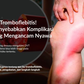 Tromboflebitis: Gejala, Penyebab, Pengobatan dan Pencegahannya