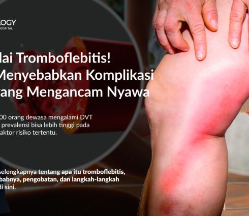 Tromboflebitis: Gejala, Penyebab, Pengobatan dan Pencegahannya