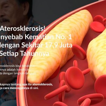 Aterosklerosis: Gejala, Penyebab, Pengobatan dan Pencegahannya