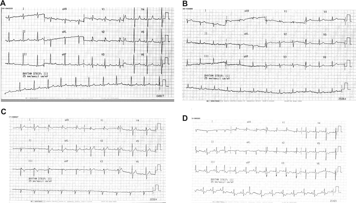 Hasil Diagnosis Atrial Septal Defect (ASD) dengan EKG