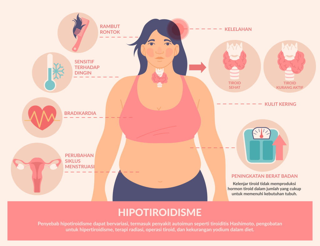 Infografis Penyakit Tiroid Hipotiroidisme