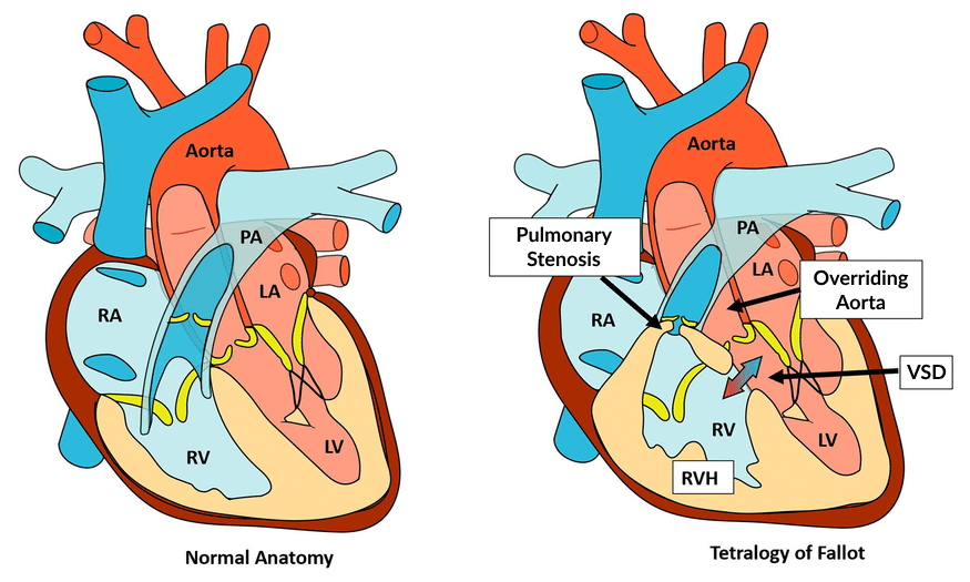 Gambar Ilustrasi Perbedaan Anatomi pada Jantung Normal dan Jantung dengan Kondisi Tetralogy of Fallot