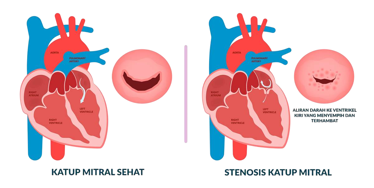 Ilustrasi Stenosis Katup Mitral