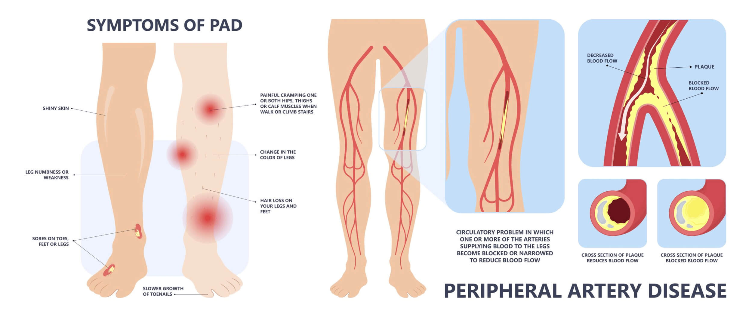 Gambar Ilustrasi Penyakit Arteri Periferal (PAD)