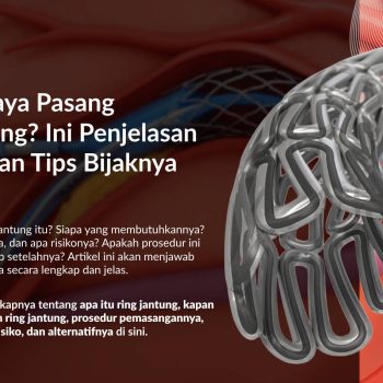 Pasang Ring Jantung (Stent): Biaya, Proses, dan Apa yang Perlu Anda Siapkan