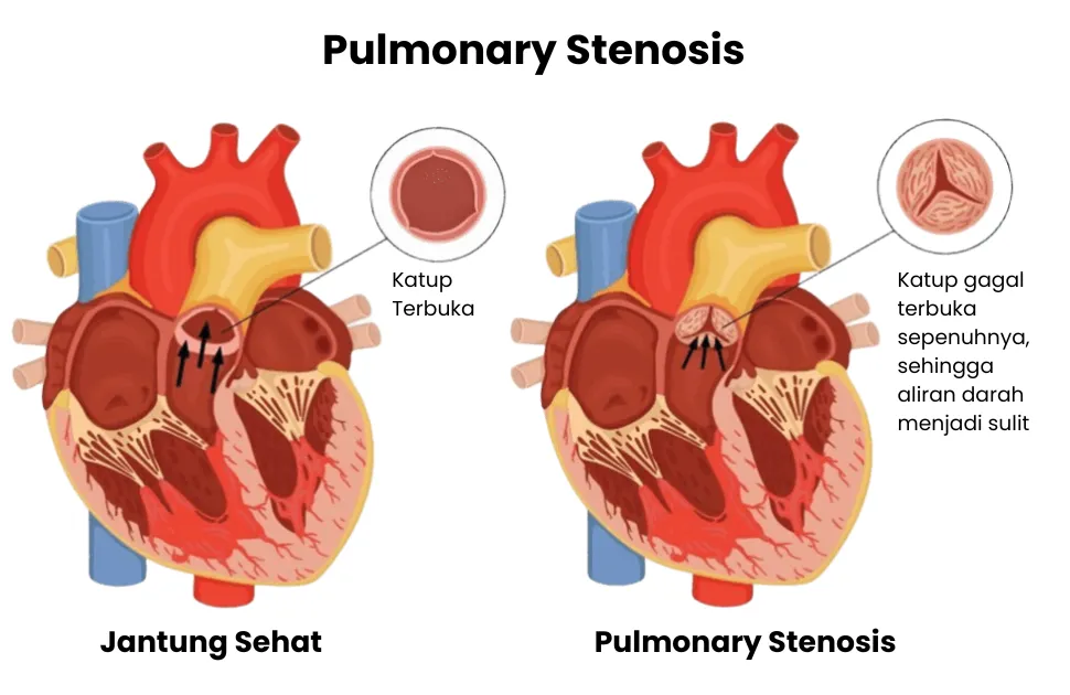Gambar Ilustrasi Medis Pulmonary Stenosis - Sumber: Continental Hospital