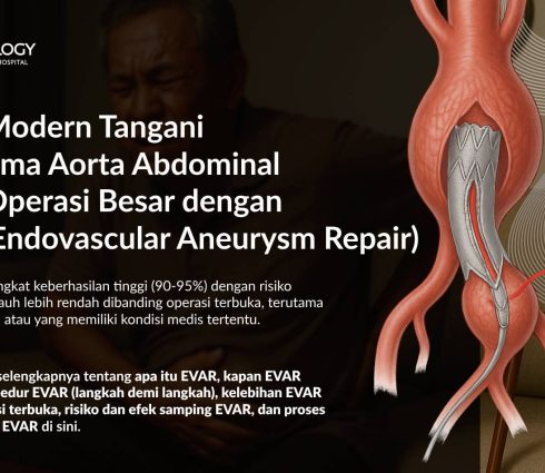EVAR (Endovascular Aneurysm Repair): Solusi Minim Invasif untuk Aneurisma Aorta Abdominal