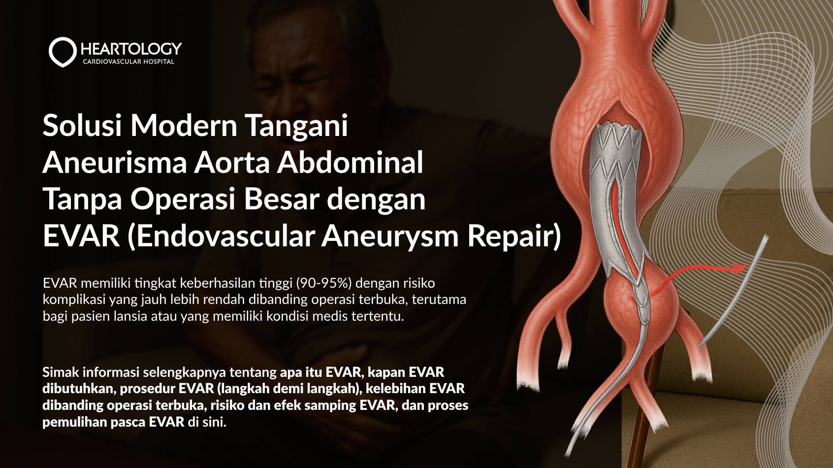 EVAR (Endovascular Aneurysm Repair): Solusi Minim Invasif untuk Aneurisma Aorta Abdominal