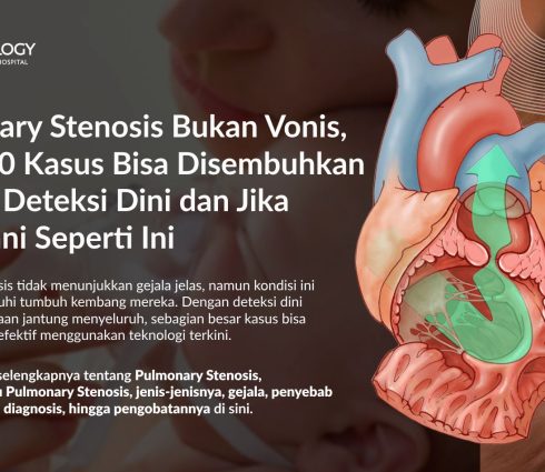 Pulmonary Stenosis: Gejala, Penyebab, Diagnosis, dan Pengobatan