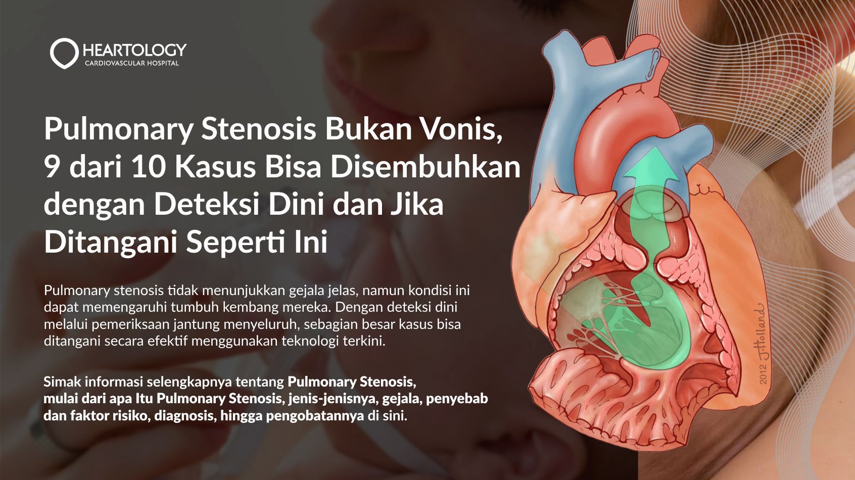Pulmonary Stenosis: Gejala, Penyebab, Diagnosis, dan Pengobatan