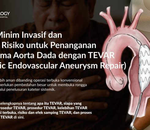 TEVAR (Thoracic Endovascular Aneurysm Repair): Solusi Minim Invasif untuk Aneurisma Aorta Torakalis