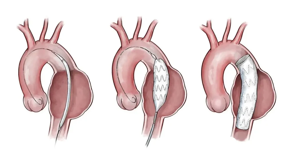 TEVAR Solusi Minim Invasif Untuk Aneurisma Aorta Torakalis TEVAR Solusi Minim Invasif Untuk Aneurisma Aorta Torakalis