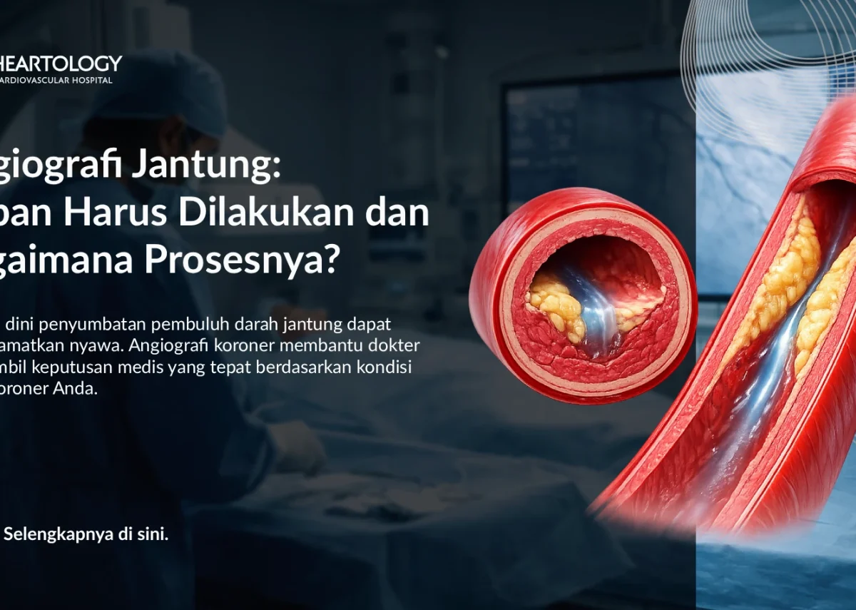 Angiografi Koroner: Kapan Harus Dilakukan dan Bagaimana Prosesnya?