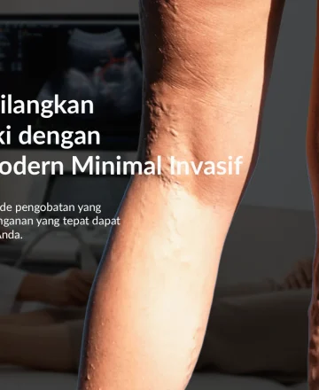 Solusi Menghilangkan Varises di Kaki dengan Perawatan Modern Minimal Invasif
