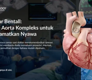Operasi Bentall untuk Penyakit Aorta: Harapan Baru bagi Pasien