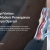 Skleroterapi Varises: Alternatif Modern Penanganan Varises Tanpa Operasi