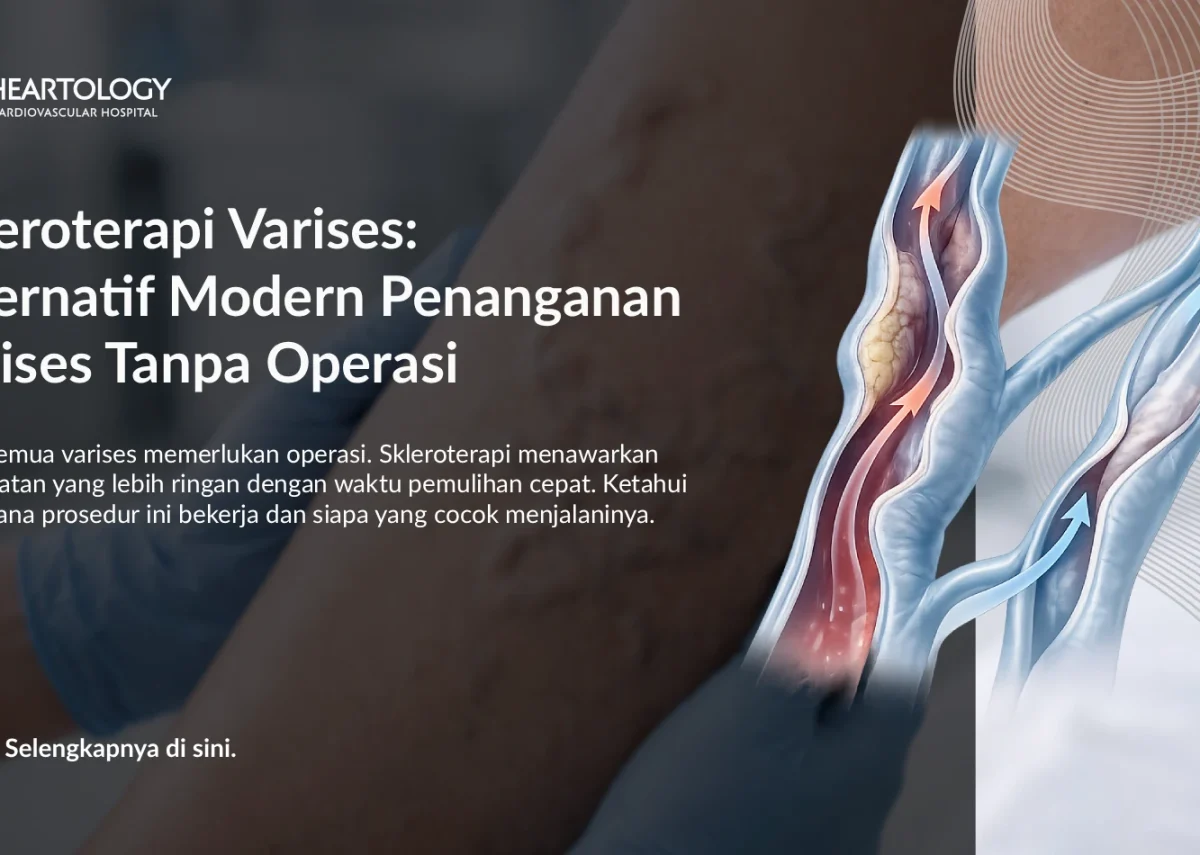 Skleroterapi Varises: Alternatif Modern Penanganan Varises Tanpa Operasi