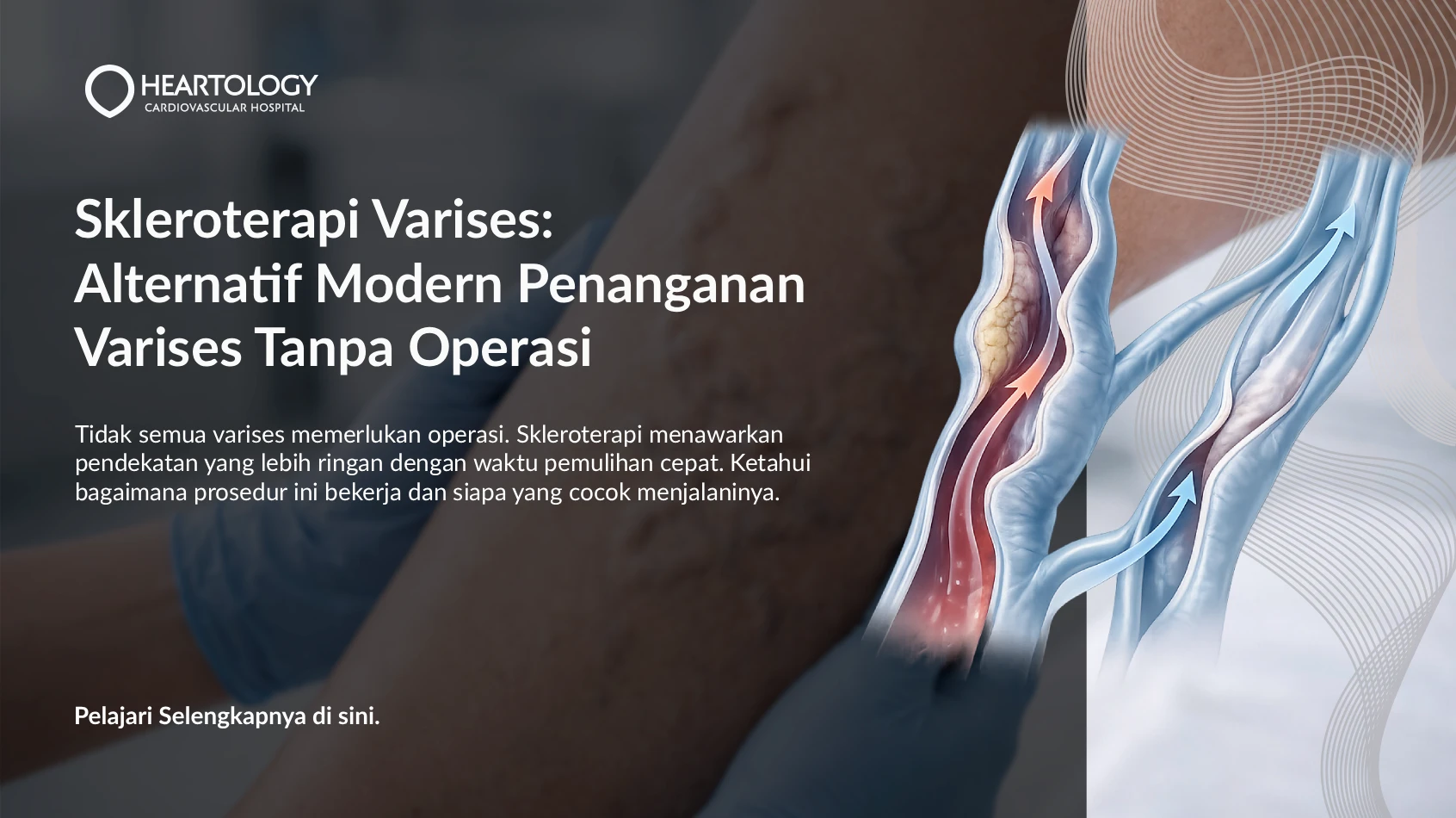 Skleroterapi Varises: Alternatif Modern Penanganan Varises Tanpa Operasi