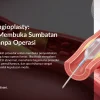 Balloon Angioplasty untuk Sumbatan Jantung: Cara Kerja & Manfaat