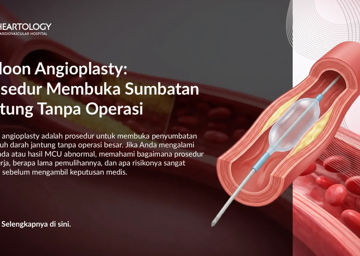 Balloon Angioplasty untuk Sumbatan Jantung: Cara Kerja & Manfaat