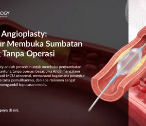 Balloon Angioplasty untuk Sumbatan Jantung: Cara Kerja & Manfaat