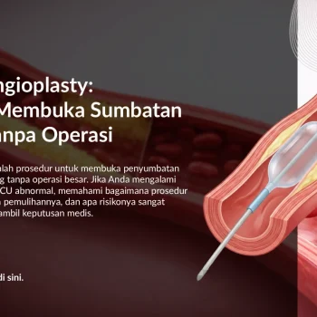 Balloon Angioplasty untuk Sumbatan Jantung: Cara Kerja & Manfaat