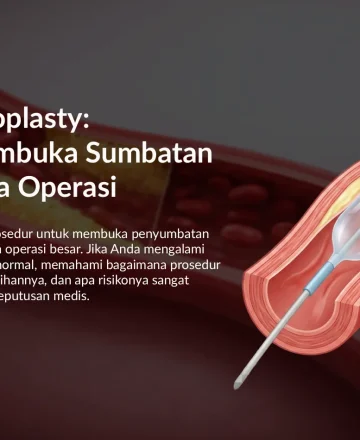 Balloon Angioplasty untuk Sumbatan Jantung: Cara Kerja & Manfaat
