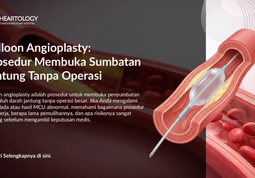 Balloon Angioplasty untuk Sumbatan Jantung: Cara Kerja & Manfaat