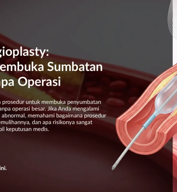 Balloon Angioplasty untuk Sumbatan Jantung: Cara Kerja & Manfaat