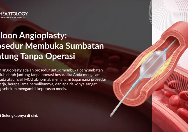 Balloon Angioplasty untuk Sumbatan Jantung: Cara Kerja & Manfaat