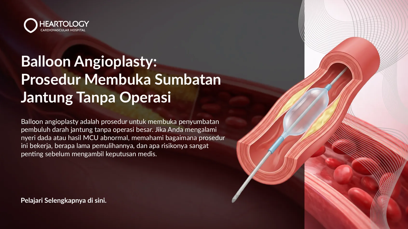 Balloon Angioplasty untuk Sumbatan Jantung: Cara Kerja & Manfaat