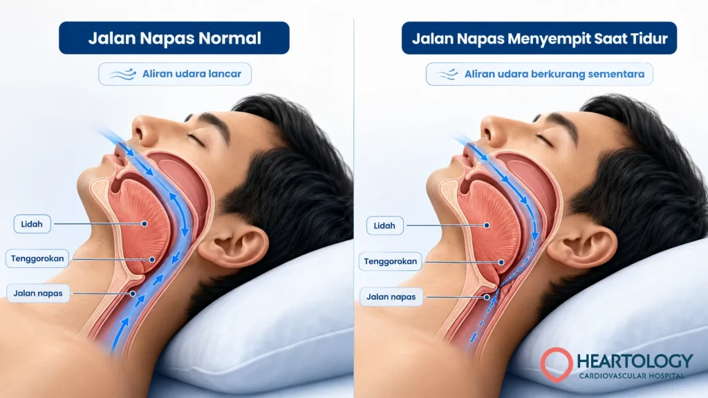 Infografis perbandingan jalan napas normal dan jalan napas menyempit saat tidur pada sleep apnea, menampilkan potongan samping kepala dan leher dengan panah aliran udara, lidah, tenggorokan, dan jalan napas.