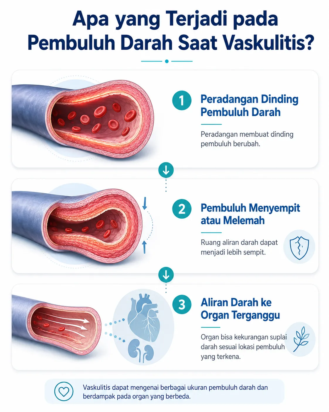 Infografis tentang vaskulitis yang menunjukkan peradangan dinding pembuluh darah, pembuluh yang menyempit atau melemah, serta aliran darah ke organ yang dapat terganggu.