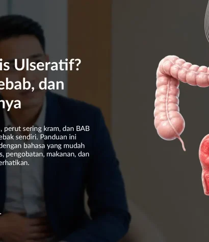 Kolitis Ulseratif: Gejala, Penyebab, Pemeriksaan, dan Pengobatan
