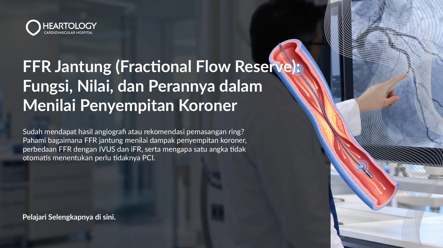 FFR Jantung (Fractional Flow Reserve): Fungsi, Nilai, dan Perannya dalam Menilai Penyempitan Koroner