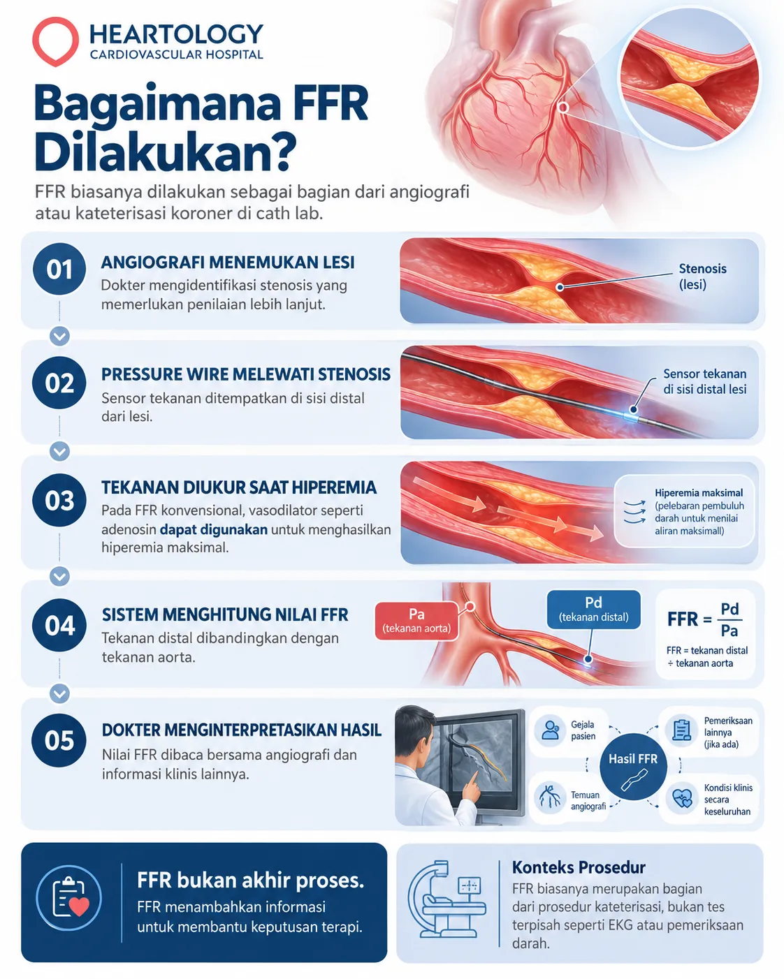 Infografik medis berbahasa Indonesia tentang cara FFR jantung dilakukan dalam 5 langkah, menjelaskan proses dari angiografi yang menemukan penyempitan koroner, pressure wire melewati stenosis, pengukuran tekanan saat hiperemia, perhitungan nilai FFR, hingga interpretasi hasil bersama informasi klinis lainnya.
