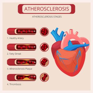 Atherosclerosis stages. Heart strokes thrombus attack blood circulatory system vector medical infographics